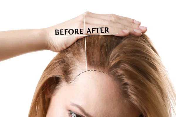 hairline reconstruction